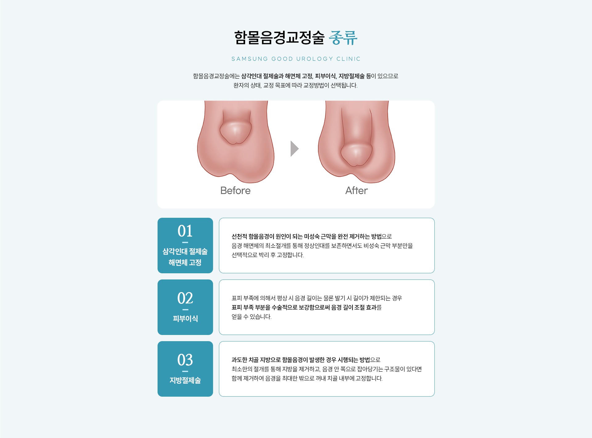 남성수술 클리닉