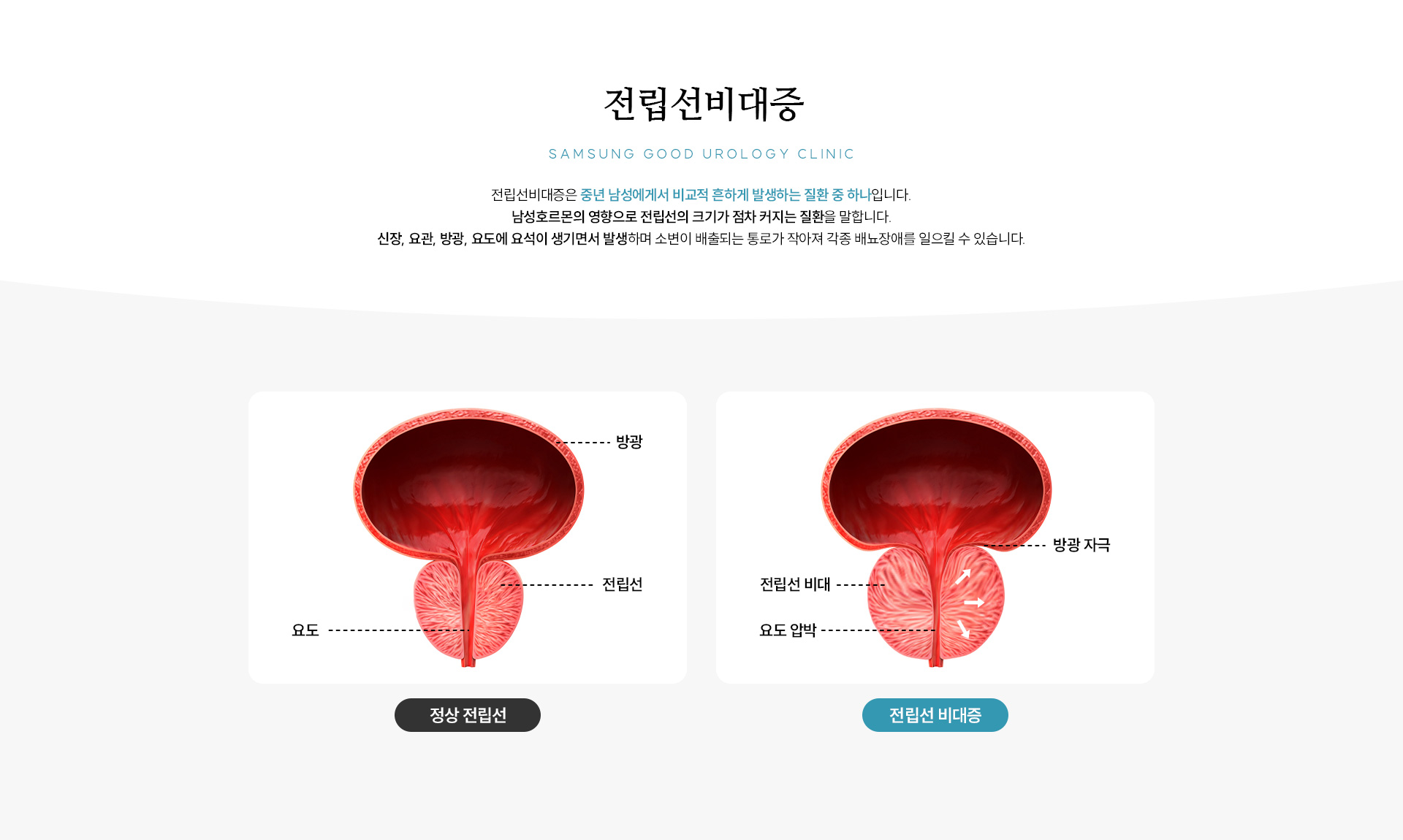 전립선비대증