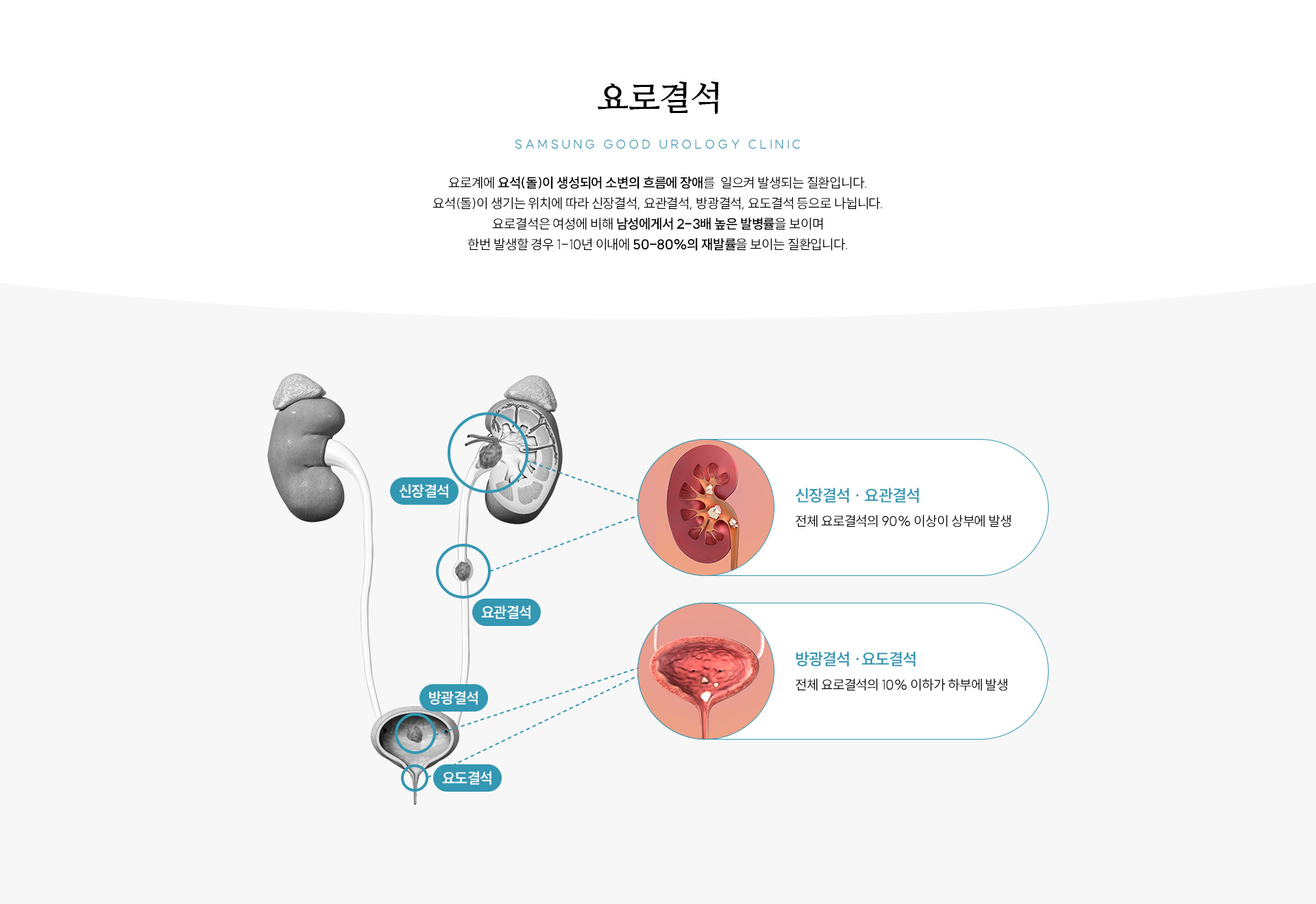 요로결석